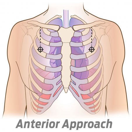 Декомпрессионная игла SPEAR Simplified Pneumothorax Emergency Air Release, NAR, 10 ga